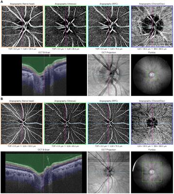 Applications of optical coherence tomography angiography in glaucoma: current status and future directions